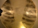 X-RAY 78rpm PETR LESHCHENKO Marfusha foxtrot USSR RARE AUDIO ROENTGEN Ribs