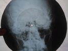 Rolling Stones - Gimme Shelter - X-RAY - USSR ROENTGEN Bones Record - Skull