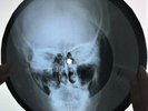Pink Floyd - Eclipse  X-RAY USSR ROENTGEN Bones SKULL