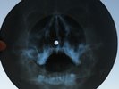 DAVID BOWIE - OWER THE WALL WE GO - GEORGIAN X-RAY ROENTGEN SKULL BONES RECORD