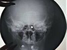 David Bowie - Black Country Rock X-RAY USSR ROENTGEN Bones Records SKULL