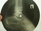 X-RAY 78rpm ELVIS PRESLEY Loving you UNIQUE USSR ROENTGEN BONES Leg Foot 1960s