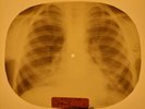 Shadows - Apache X-RAY OF THE USSR X-RAY BONES RECORDING