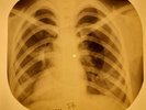 Van Morrison - Brown Eyed Girl X-RAY OF USSR X-RAY BONE RECORD