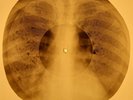 David Bowie - Space Oddity  X-RAY OF USSR X-RAY BONES RECORD