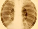 X-RAY USSR ROENTGEN BONES RECORD ORIGINAL OLD RIBS 695